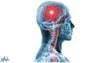 “فهد الطبية” توضح ما المقصود بتمدد الأوعية الدموية الدماغي وما هي أعراضه وعوامل خطورته
