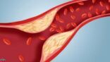 «استشاري أمراض قلب» يوضح 3 أدوية ترفع مستوى الدهون في الدم