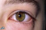 هل كورونا يصيب الأطفال بمضاعفات نادرة في العيون؟.. حالة مرضية تكشف التفاصيل